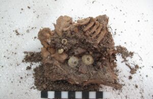 Η πρώτη γνωστή περίπτωση συνδρόμου Down κατά την αρχαιότητα στην Ελλάδα