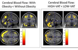Το κρυμμένο λίπος «προβλέπει» το Αλτσχάιμερ 20 χρόνια πριν την εμφάνιση των πρώτων συμπτωμάτων