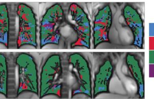 Ανωμαλίες στους πνεύμονες παρατηρήθηκαν σε παιδιά και έφηβους με long Covid